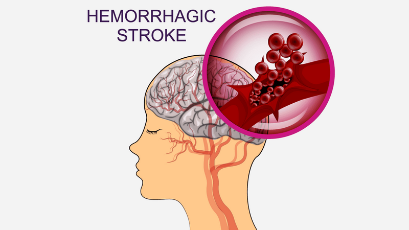 7 phương pháp chống đột quỵ bạn có thể thực hiện 1