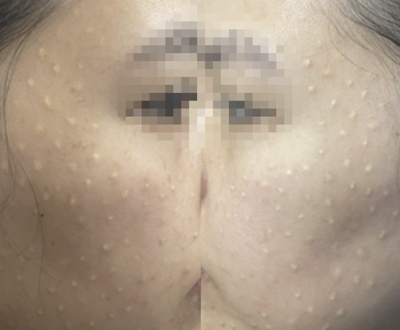 Meso khác filler phải không? Giải đáp từ chuyên gia 4