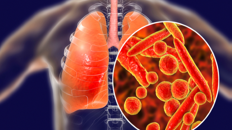 Bệnh nhân mắc bệnh lao phổi có chết không? 2