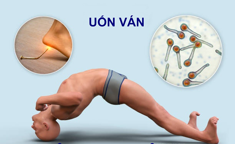 Bệnh uốn ván và tiêm phòng - Thai 37 tuần tiêm uốn ván được không? 1