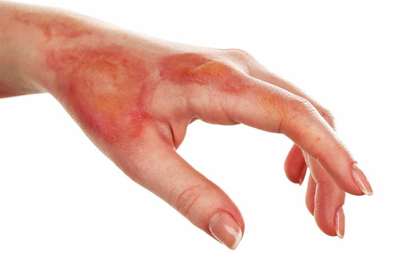 Bị phồng ăn thịt gà được không? 2