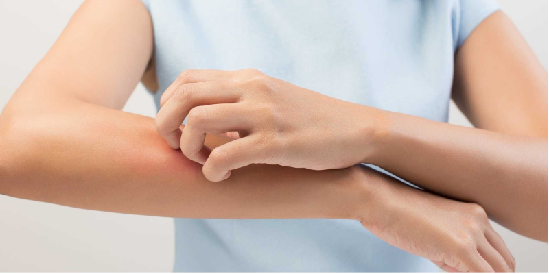 Cách xử trí và phòng ngừa trong trường hợp bị dị ứng cá biển 3