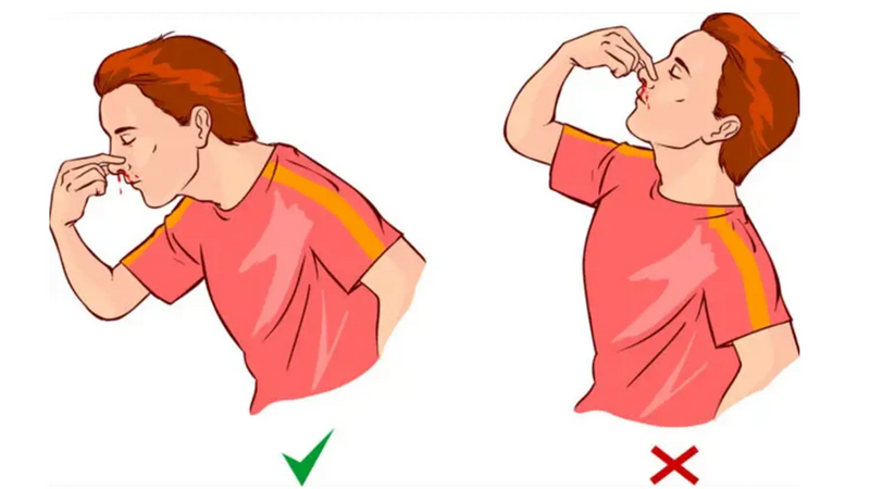 Cảnh báo các bệnh lý nguy hiểm do chảy máu mũi thường xuyên và cách khắc phục hiệu quả 5