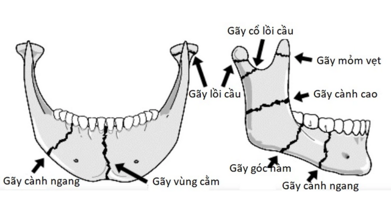 Chi phí phẫu thuật gãy xương hàm 1