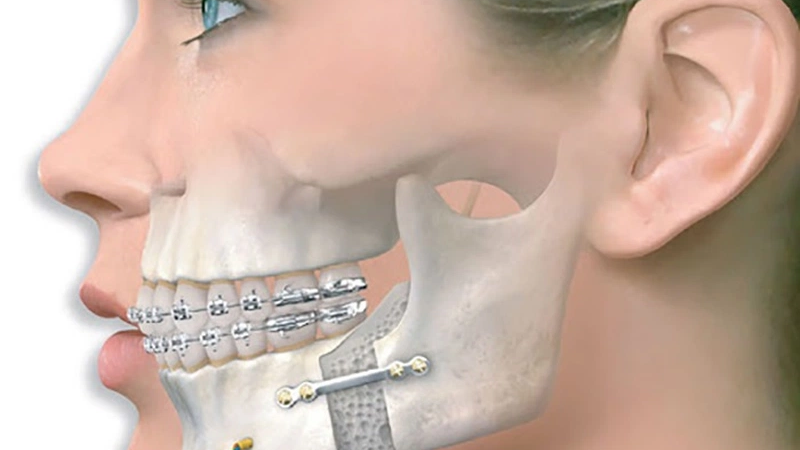 Chi phí phẫu thuật gãy xương hàm 5