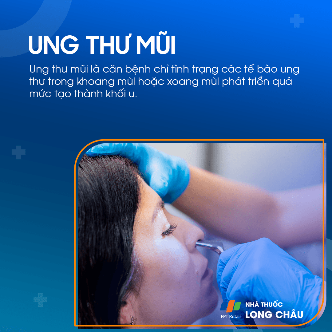 Ung thư mũi là gì? Nguyên nhân, triệu chứng và cách điều trị