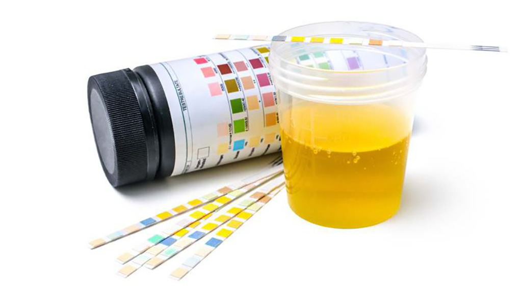 Đặc điểm nước tiểu của người bị tiểu đường như thế nào 2