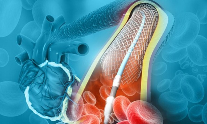 Đặt stent niệu quản là gì? Giải thích chi tiết 2
