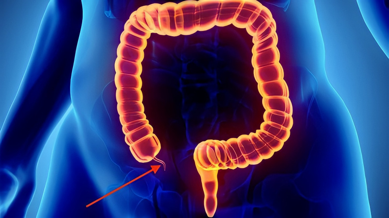 Đau ruột thừa: Các nguyên nhân chính và cách điều trị `