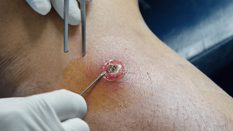 Đau ruột thừa: Các nguyên nhân chính và cách điều trị 3