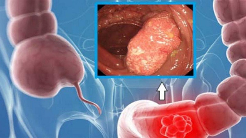 Điều trị tắc ruột: Những điều bạn cần biết 2