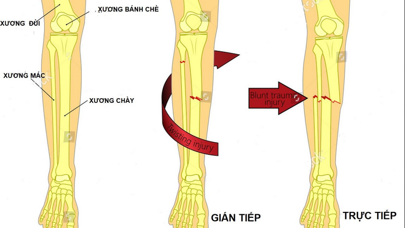 Gãy 1/3 dưới xương chày 3