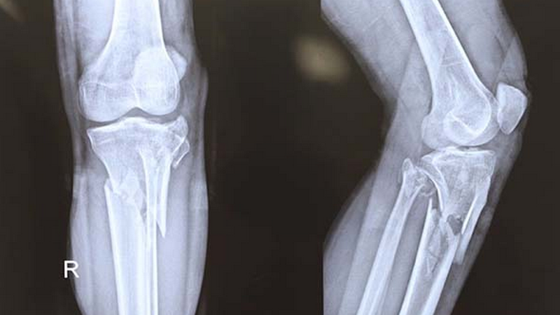 Gãy 1/3 dưới xương chày 5