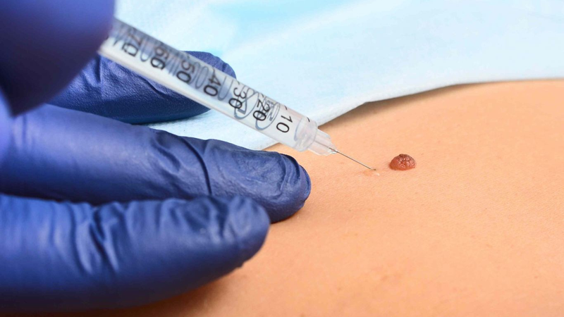 Gây tê là gì? Phân loại và các lưu ý cần biết 1