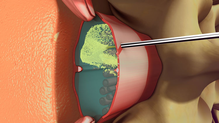 Gây tê là gì? Phân loại và các lưu ý cần biết 2