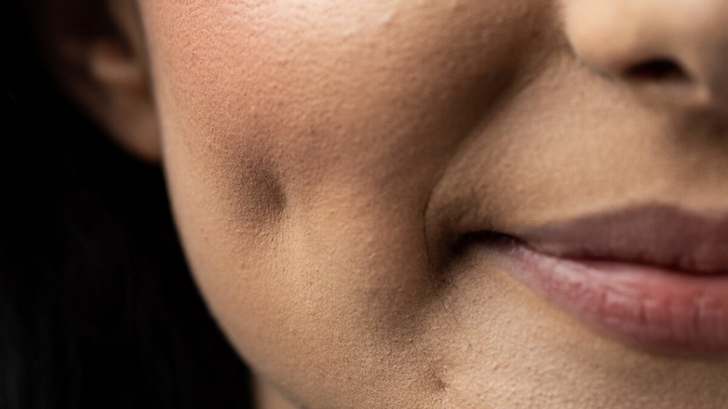 Giải đáp từ chuyên gia thẩm mỹ: Tạo má lúm có để lại sẹo không? 1