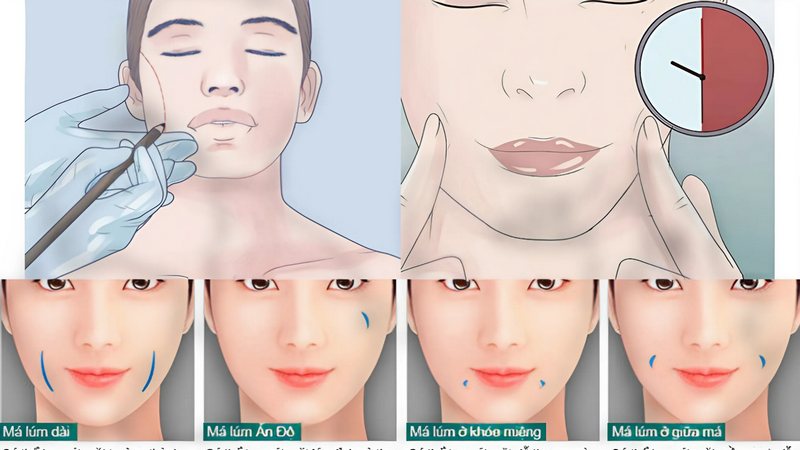 Giải đáp từ chuyên gia thẩm mỹ: Tạo má lúm có để lại sẹo không? 4