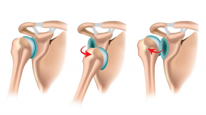 Góc hỏi đáp: Trật khớp vai có phải mổ không? 1