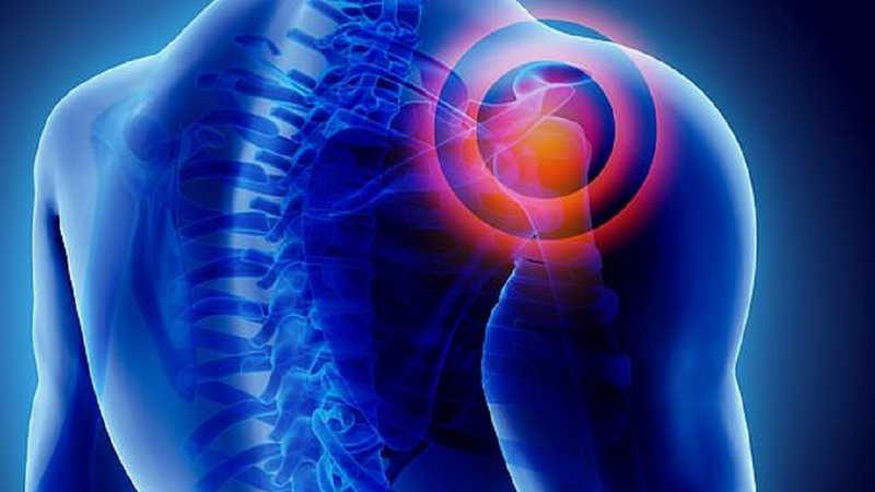 Góc hỏi đáp: Trật khớp vai có phải mổ không? 5