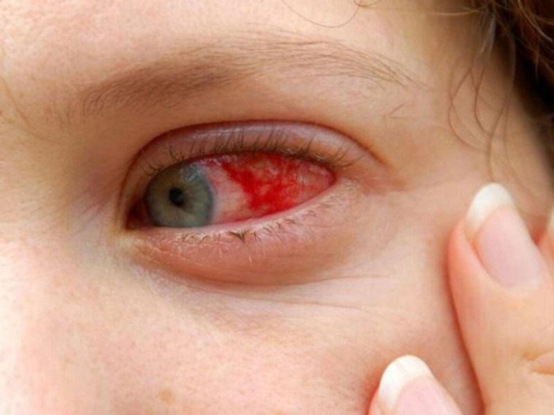 Hội chứng ảo giác Charles Bonnet 02