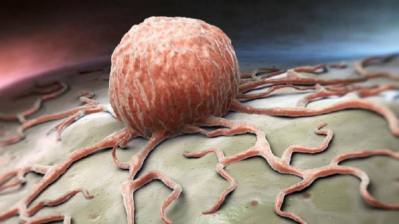 Hội chứng thần kinh cận ung 2.jpg