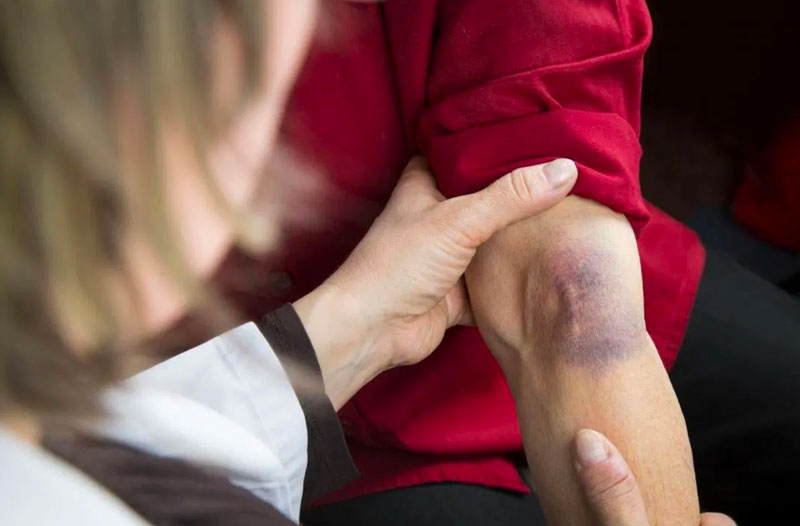 Hút dịch khớp cổ tay: Các lưu ý cần hiểu rõ 3