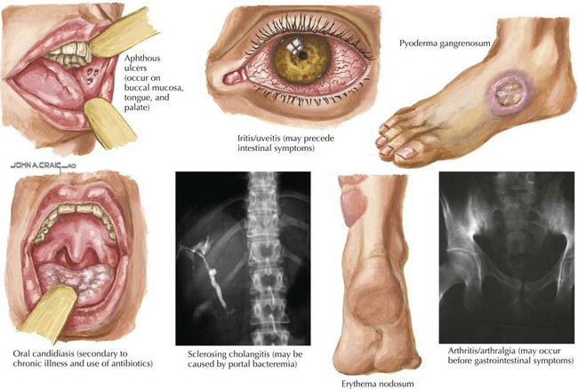 Viêm ruột mạn tính là gì? Những vấn đề cần biết về viêm ruột mạn tính 1