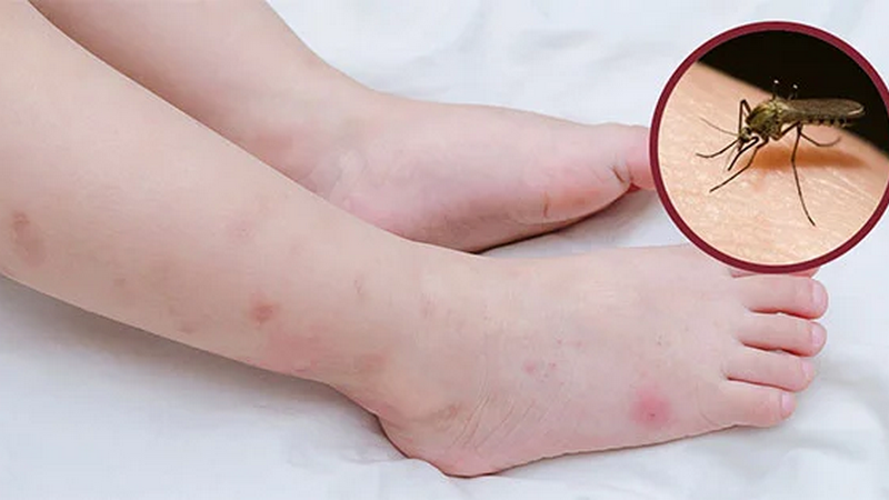 Kem bepanthen có bôi được vết muỗi đốt không? 3