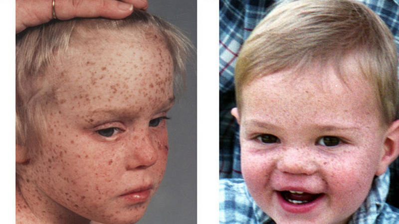 Khô da sắc tố - Dấu hiệu, nguyên nhân và cách điều trị 1