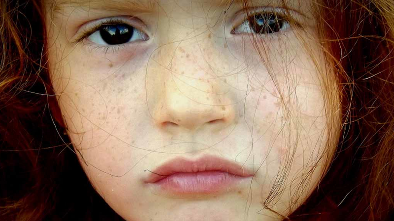 Khô da sắc tố - Dấu hiệu, nguyên nhân và cách điều trị 3