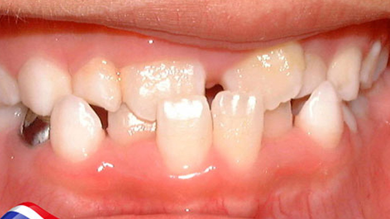 Khớp cắn ngược ở trẻ em có nguy hiểm không? Điều trị thế nào? 2