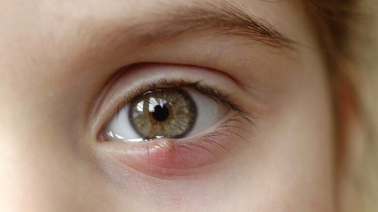 Lý do làm cho mí mắt nổi mụn trắng nhỏ là gì 3