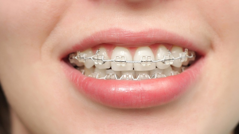 Mài gồ xương ô răng: Giải pháp điều trị răng hô và cười hở lợi hiệu quả 2