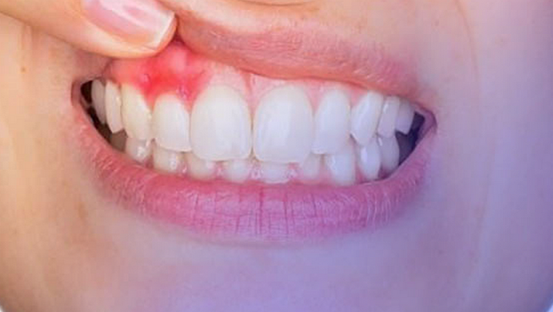 Mài gồ xương ô răng: Giải pháp điều trị răng hô và cười hở lợi hiệu quả 3