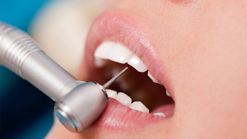 Mài gồ xương ô răng: Giải pháp điều trị răng hô và cười hở lợi hiệu quả 4