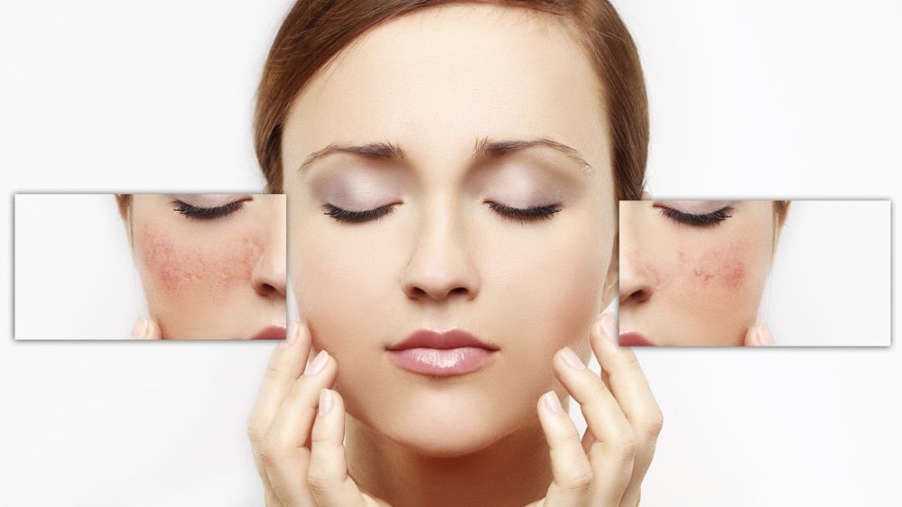 Melaleuca Alternifolia là gì? Công dụng của Melaleuca Alternifolia đối với làn da 3