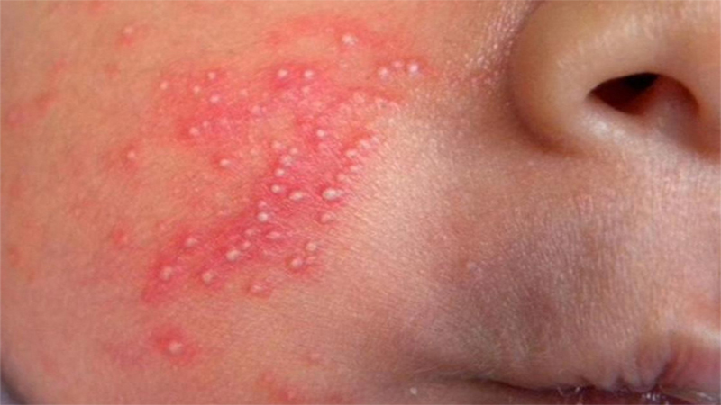 Mụn trứng cá ở trẻ sơ sinh có đáng lo ngại không? 1