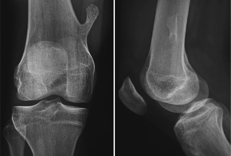 Nang xương đơn độc là gì? Làm sao để chữa khỏi? 3