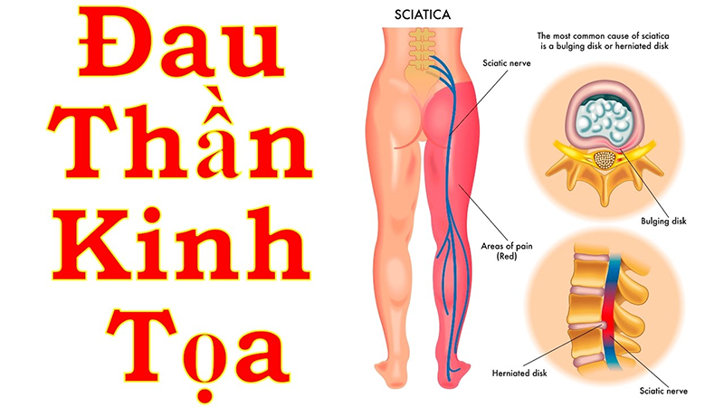 Ngâm chân chữa đau thần kinh tọa: Giải pháp tự nhiên tại nhà 2