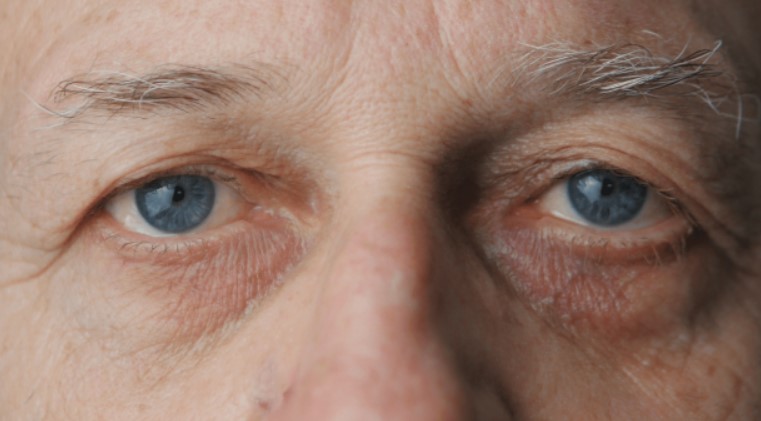 Nguyên nhân tăng nhãn áp 02