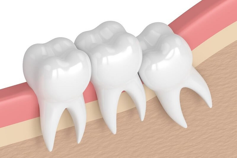 Nhổ răng khôn xong bị đau răng bên cạnh 03