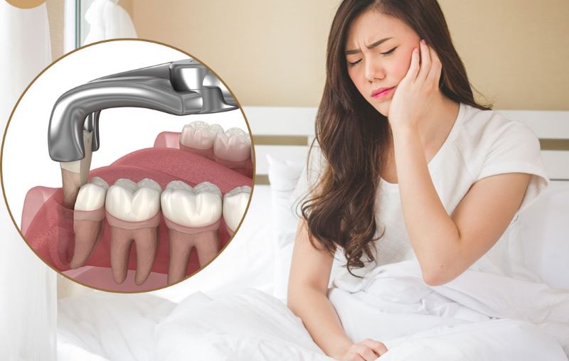 Nhổ răng nanh có nguy hiểm không? Nên làm thế nào? 4