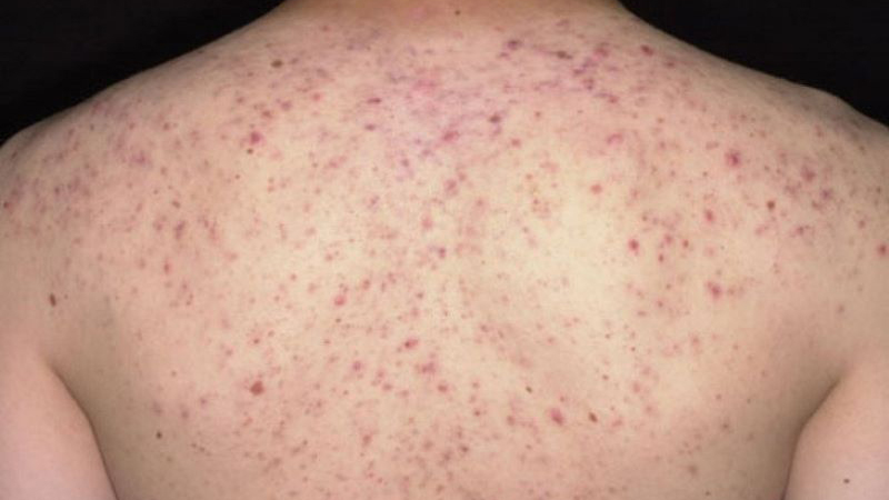 Rối loạn sắc tố da là gì? LàRối loạn sắc tố da là gì? Làm cách nào điều trị rối loạn sắc tố da? 1m cách nào điều trị rối loạn sắc tố da?