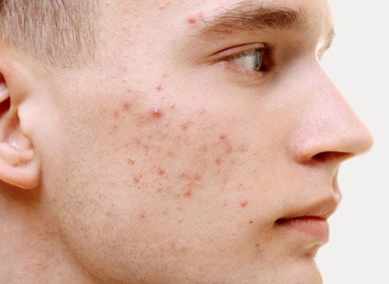 Thủ dâm có nổi mụn không 03