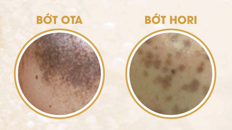 Tình trạng bớt sắc tố ở da: Phân loại, nguyên nhân và cách điều trị 2