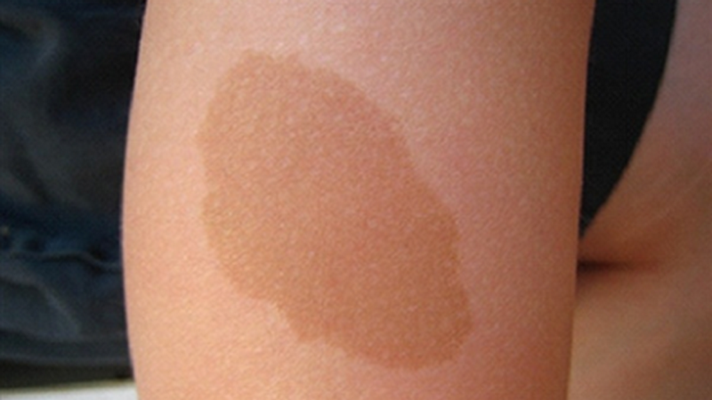 Tình trạng bớt sắc tố ở da: Phân loại, nguyên nhân và cách điều trị 4