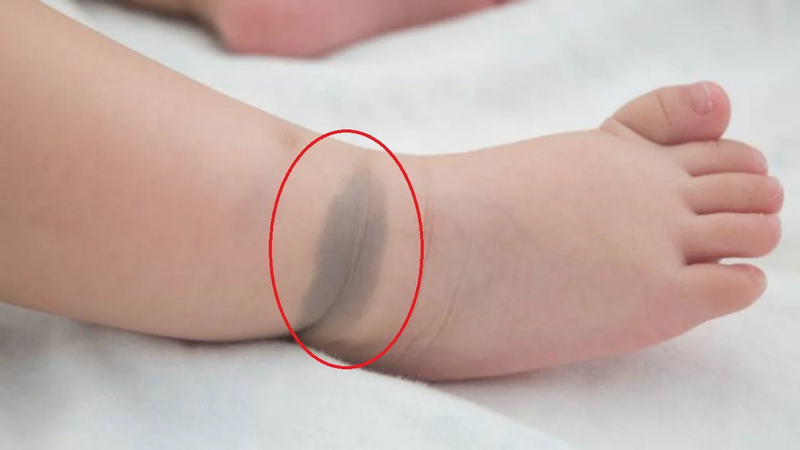 Tình trạng bớt sắc tố ở da: Phân loại, nguyên nhân và cách điều trị 5