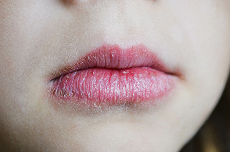 Tổng hợp các nguyên nhân phổ biến gây viêm môi cơ địa 1