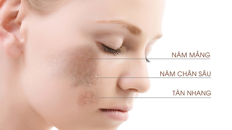 Top 4 loại nước ép trị nám hiệu quả ngay tại nhà 2