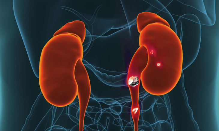 Triệu chứng sỏi tiết niệu 01